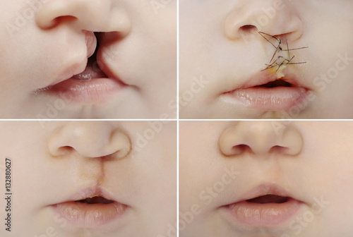 Close up on the lips of baby before and after lip and palate cleft  surgery.