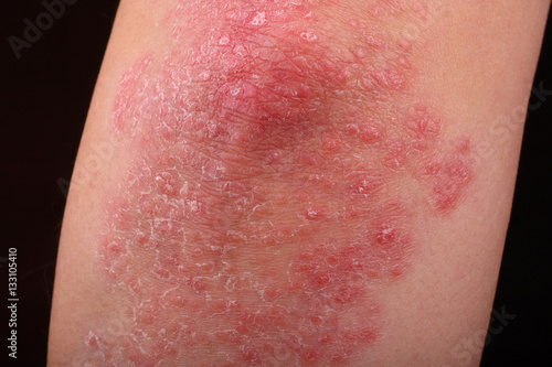 psoriasis