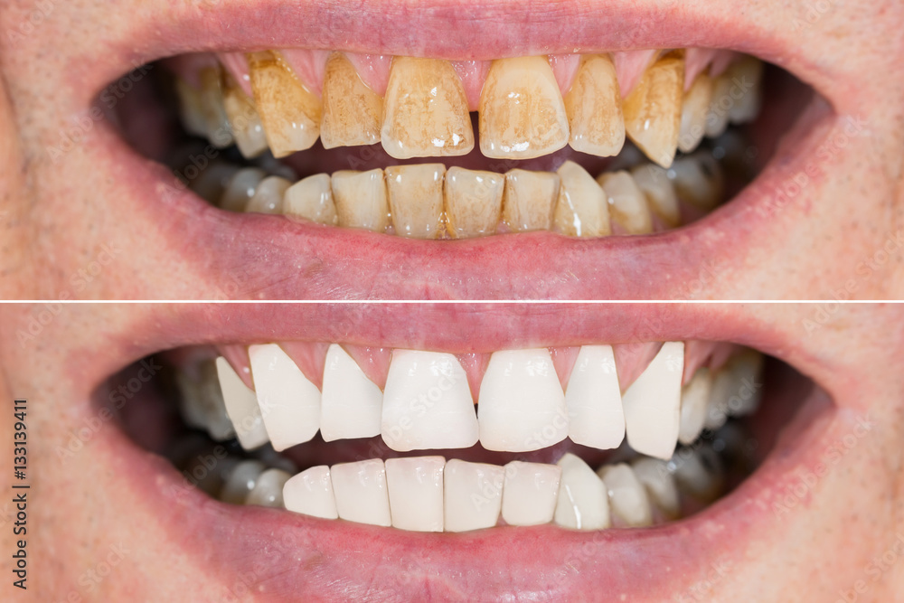 Fototapeta premium Man Teeth Before And After Whitening
