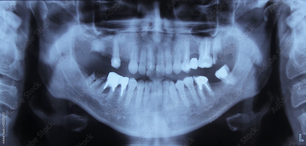 x-ray of teeth x-ray of teeth