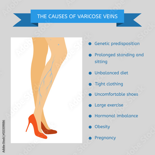 The causes of varicose veins. Infographics. Female legs in red shoes in profile