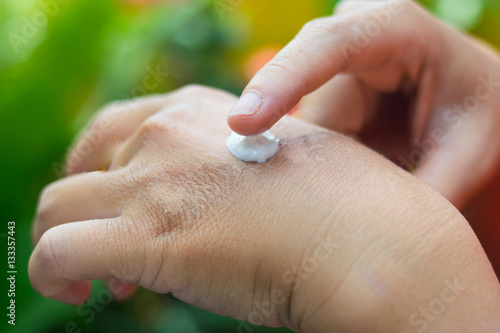 scalded hand,Treatment of burns on female hand