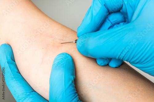 Doctor taking a blood sample for blood test from vein