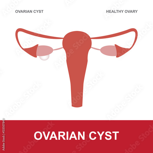 vector illustration of ovarian cyst and healthy ovary
