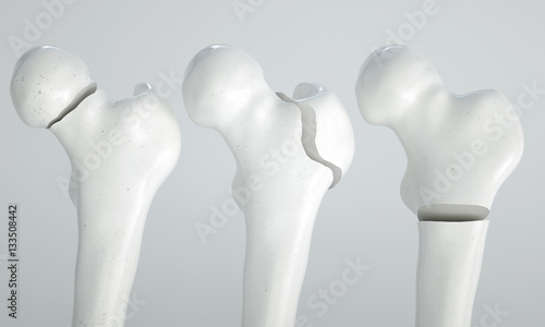 Fracture of the femur - breakpoints 1 4 - 3D Rendering