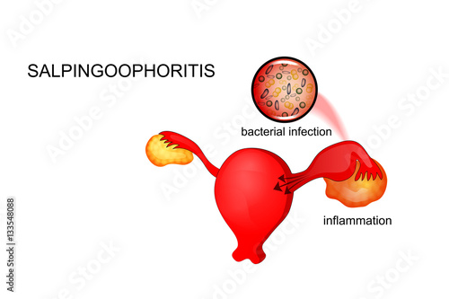 vector illustration of oophoritis photo