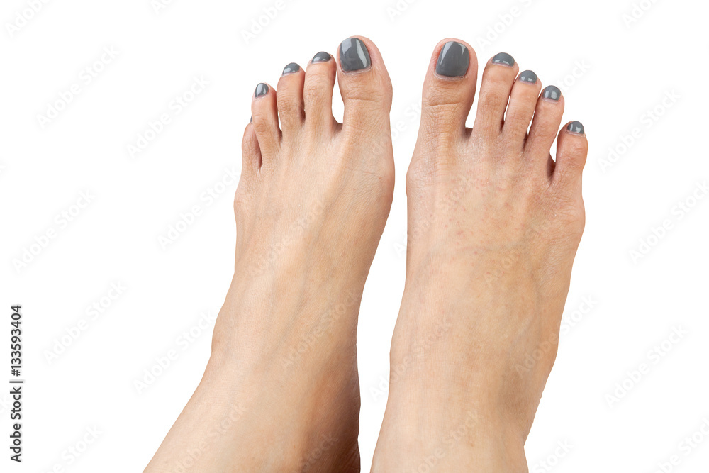 female feet with eczema infect, isolated on white background, cl female feet with eczema infect, isolated on white background, cl