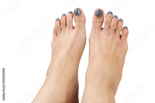 female feet with eczema infect, isolated on white background, cl