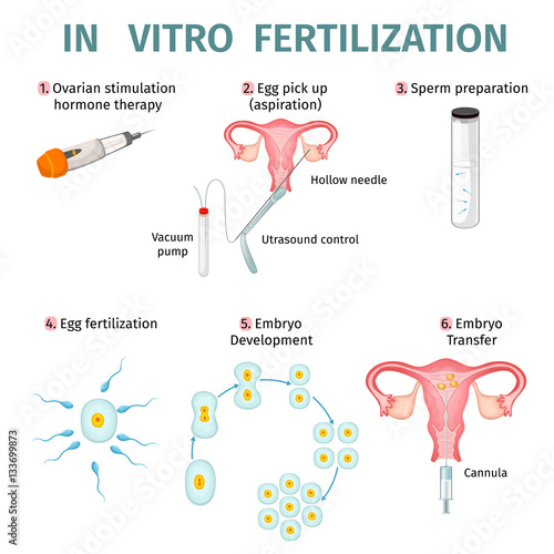 In Vitro Fertilization Concept