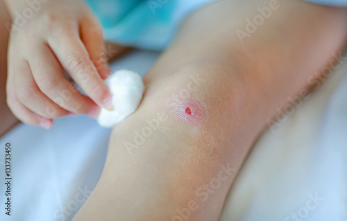 Close up wound on child knee. Mother dressing child s knee.