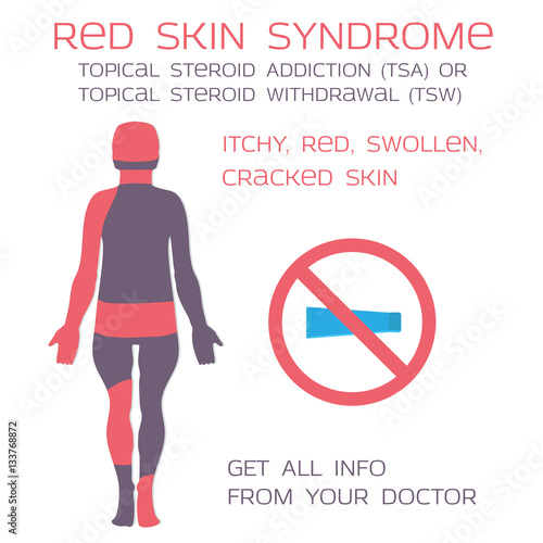 Red skin syndrome, topical steroids withdrawal or addiction. Eczema and steroids. Vector illustration.