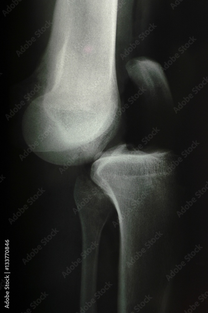 X-ray, bone dislocation after accident (model-released) X-ray, bone dislocation after accident (model-released)