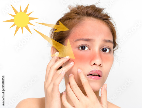 Fotografia young female with a bad sunburn on her face
