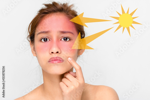 young female with a bad sunburn on her face