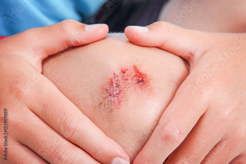 Child holding their knee after getting a scrape