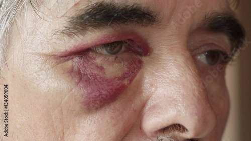 black eyes of middle age boxer after fight photo