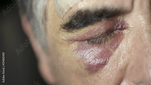 black eye of Caucasian man 50 years photo