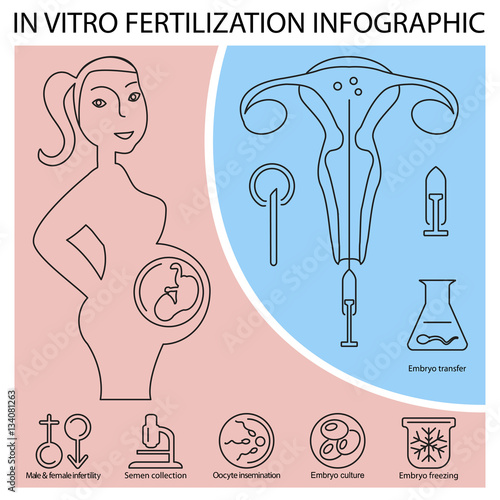 In vitro fertilization infographic. Illustration showing egg retrieval procedure, fertilization in laboratory, fertilized egg development and embryos transfer back to the uterus. Vector eps10 