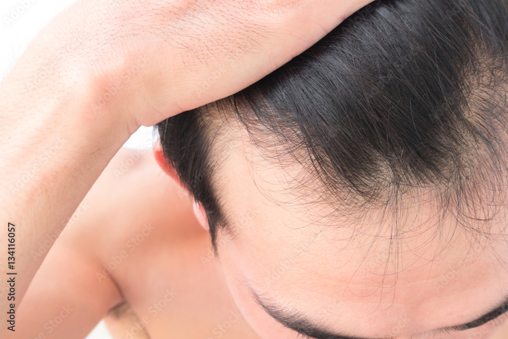 Young man worry hair loss problem for health care shampoo and be Young man worry hair loss problem for health care shampoo and be