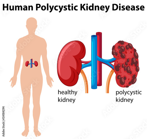 Diagram showing human polycystic kidney disease