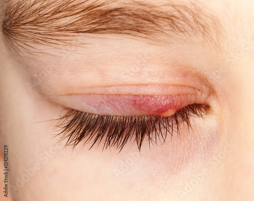 Closed eye with sty
