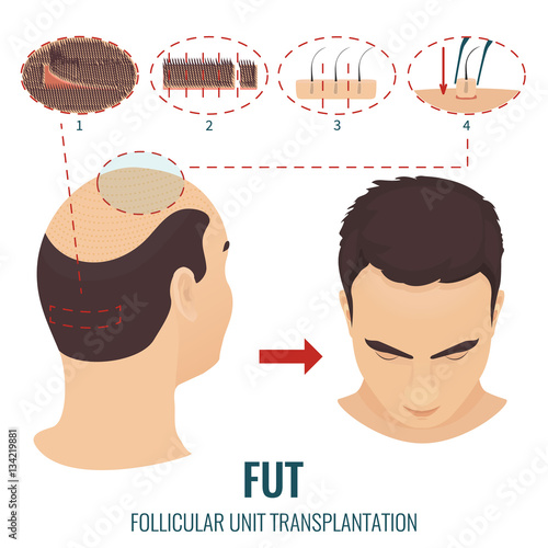 Male hair loss treatment with follicular unit transplantation. Stages of FUT procedure. Alopecia infographic medical design template. Clinics and diagnostic centers concept design. Vector illustration