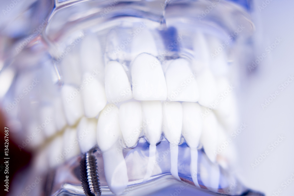 Dentists dental teeth implant Dentists dental teeth implant