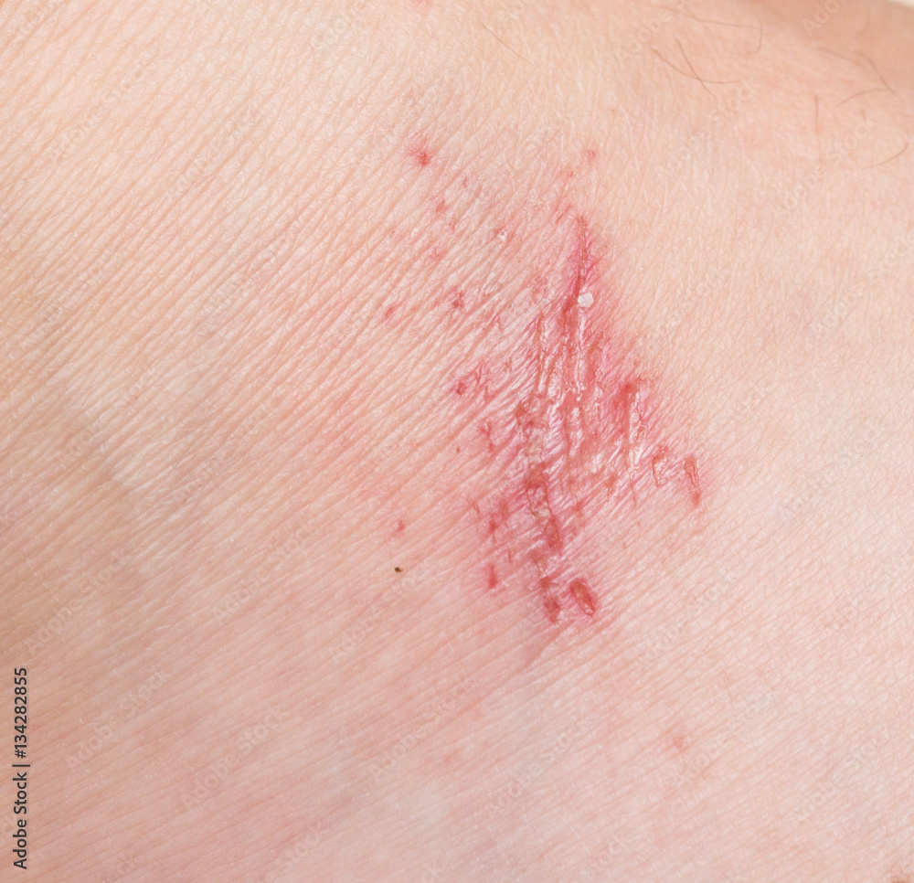 Fototapeta premium wound on skin