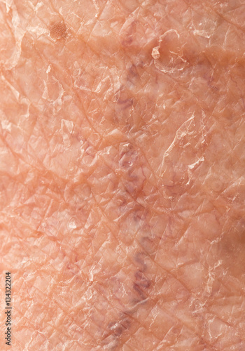 Wallpaper Mural varicose veins on the skin Torontodigital.ca