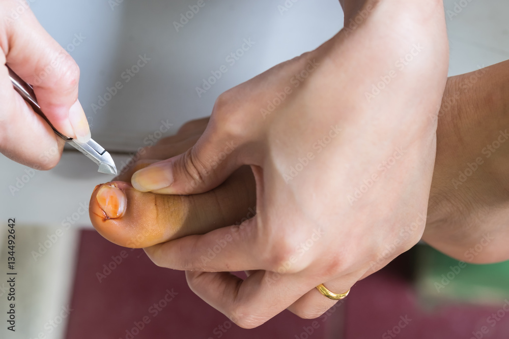 Hands removing calluses, corns and treats ingrown nail. Hardware Hands removing calluses, corns and treats ingrown nail. Hardware