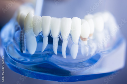 Dental teeth plaque model