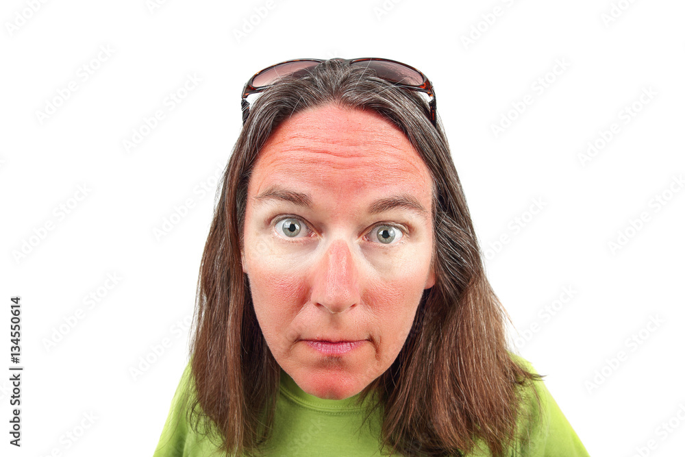 Woman with sunglasses sunburn Stock Photo | Adobe Stock