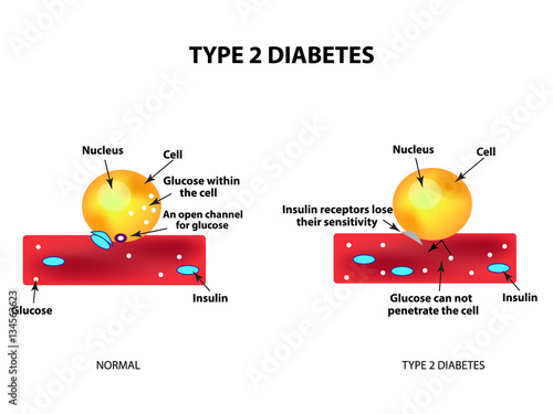 The absorption of glucose by the cell. Type 2 diabetes. Increase and decrease blood sugar. Insulin. Infographics. Vector illustration on isolated background