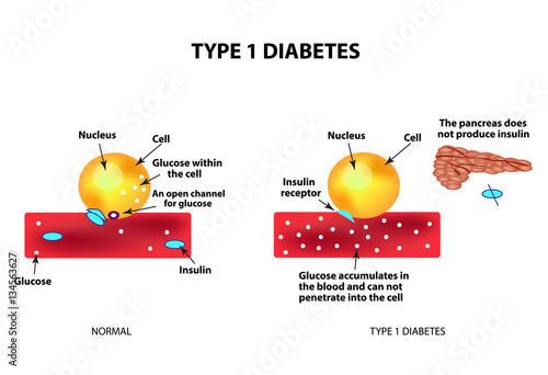 The absorption of glucose by the cell. Type 1 diabetes. Increase and decrease blood sugar. Insulin. Infographics. Vector illustration on isolated background