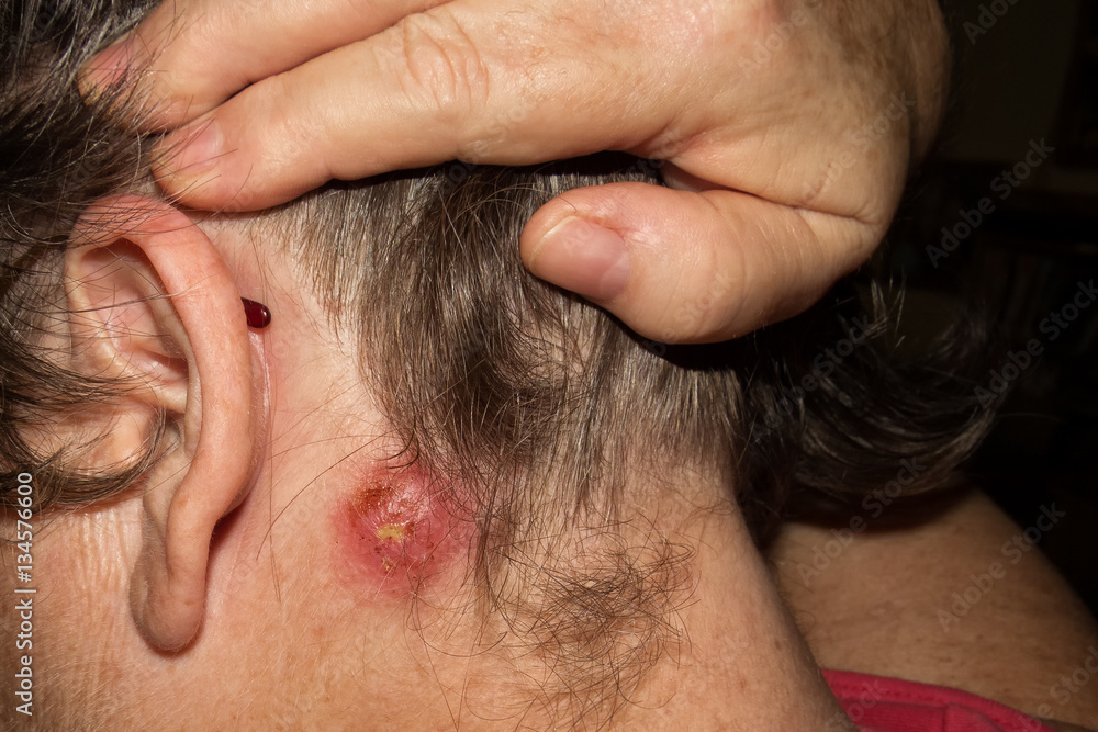 Staph Infection on mature woman behind ear Staph Infection on mature woman behind ear