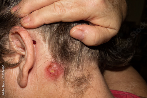 Staph Infection on mature woman behind ear
