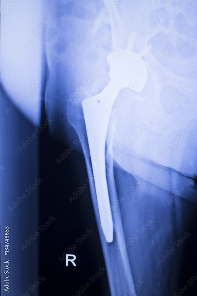 Naklejka premium Hip joint replacement xray