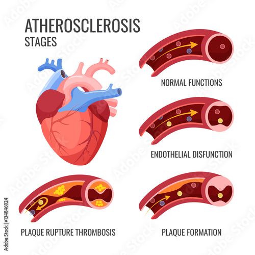 Atherosclerosis stages. Normal functions, endothelia disfunction, plaque formation, rupture thrombosis