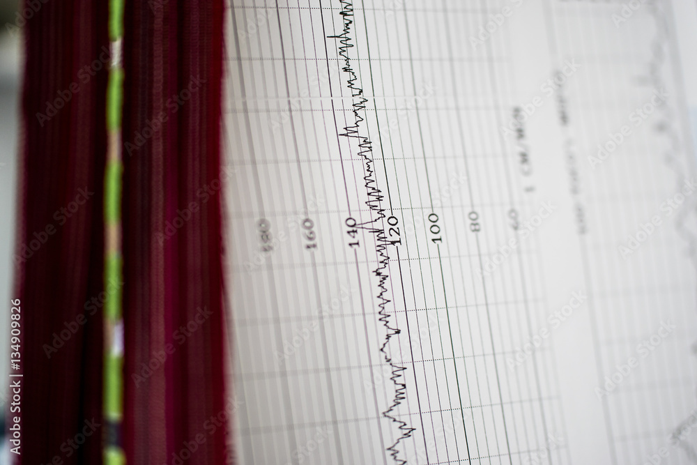 Heart rate monitor reading from a cardiogram for baby foetus heart rate and strap to keep baby monitor in place used in hospital for maternity examinations and emergency care Heart rate monitor reading from a cardiogram for baby foetus heart rate and strap to keep baby monitor in place used in hospital for maternity examinations and emergency care
