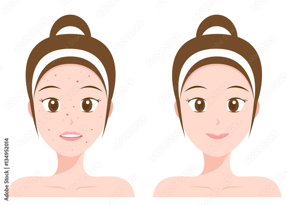 face with acne and without acne vector face with acne and without acne vector
