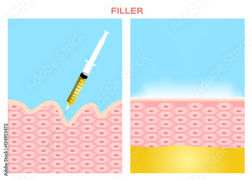 skin filler vector . It can cure the wrinkle 