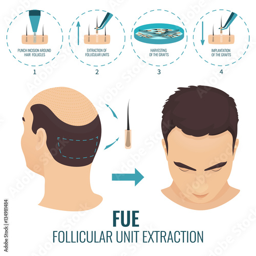 Male hair loss treatment with follicular unit extraction. Stages of FUE procedure. Alopecia infographic medical design template for transplantation clinics and diagnostic centers. Vector illustration. photo