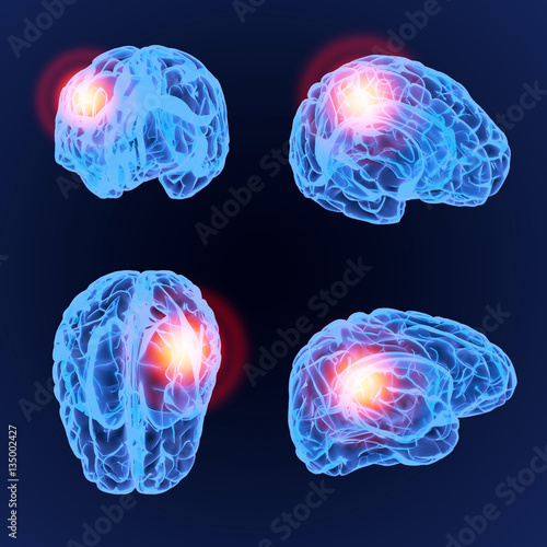 Headache X-Ray 3D model. Brain neurons synapse, anatomy body. Set of medical illustration of disease, head pain. 