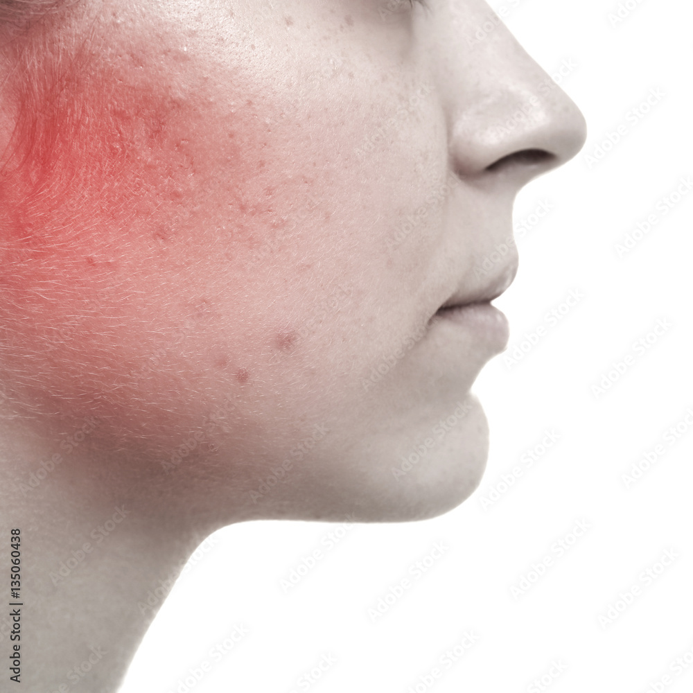 Skin care concept. Young woman with acne, closeup Skin care concept. Young woman with acne, closeup