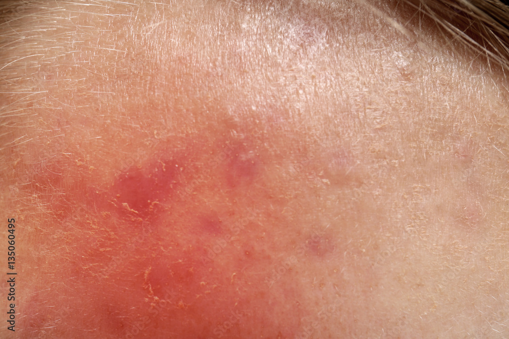 Acne treatment concept. Skin irritation, closeup Acne treatment concept. Skin irritation, closeup