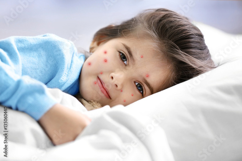 Obraz na plátně Little girl with red pimples lying in bed at home