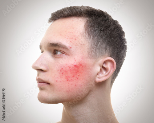 Obraz na plátně Skin care concept. Young man with acne on light background