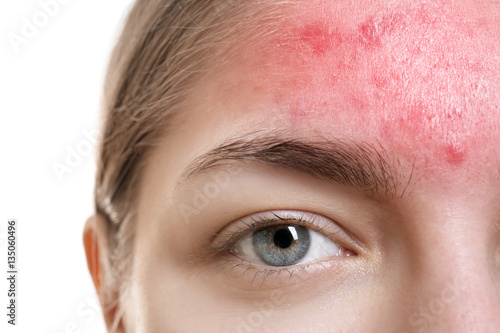 Skin care concept. Young woman with acne, closeup