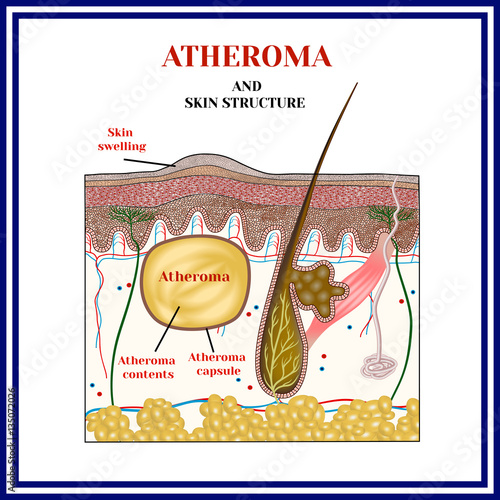 Atheroma. Cysts, tumors. Skin structure. Obstruction of the sebaceous gland.