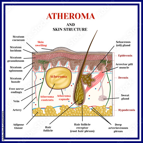 Atheroma. Cysts, tumors. Skin structure. Obstruction of the sebaceous gland.